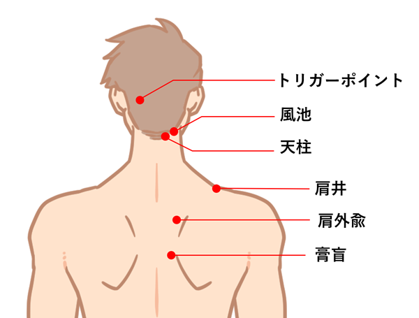 頭痛・肩こり、腰痛、膝の痛みでお悩みの方にはトリガーポイント 埼玉県桶川市の内科・外科・皮膚科のファミリーファーストクリニック診療を目指す